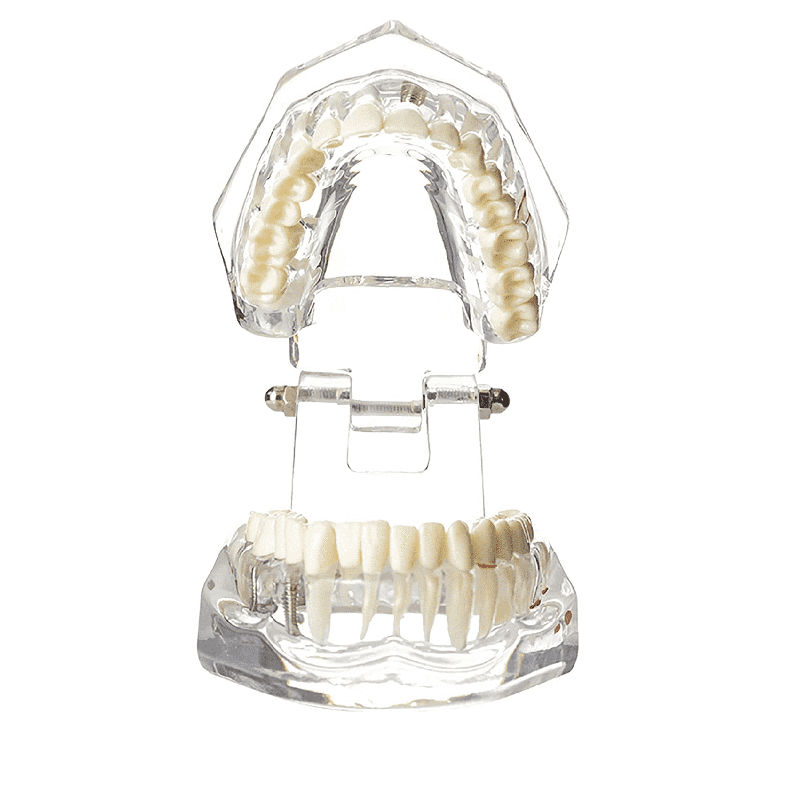  Ultrassist Transparent Disease Teeth with Dental Implant Bridge Dental Model 