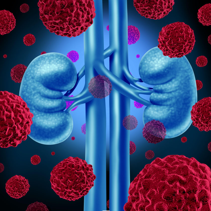 Renal Carcinoma