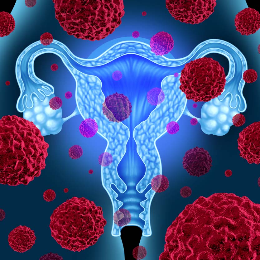 Ovarian Cancer