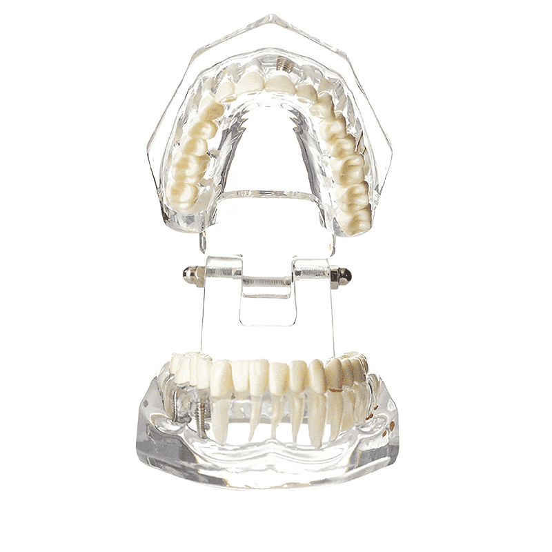 Ultrassist Transparent Disease Teeth with Dental Implant Bridge Dental Model 