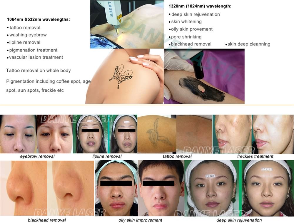 Professional Q switch Laser & Carbon Peeling System (3)