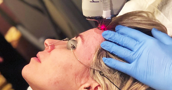 The Best Lasers To Treat Acne Scars, Fractional Co2 Laser, Fraxel throughout Laser Treatment For Acne Scars Reviews - Beauty and Health