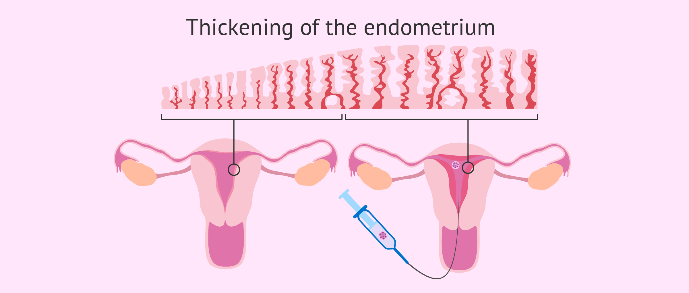 What Does Thickening Of The Womb Lining Mean Abnormally Thickened Endometrium Differential Radiology Reference Article 8mm Thick Uterine Lining After Menopause  samepagehr.com