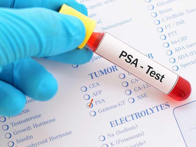 Prostate Specific Antigen PSA Rapid Test Kits OEM with Accurate Result