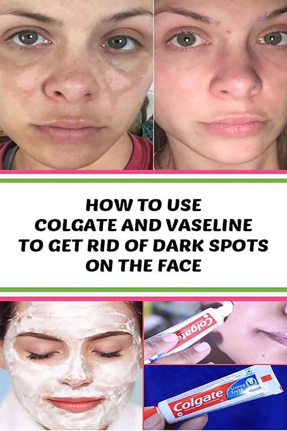 How to remove red, blue, dark spots, acne scars on the face, get rid of post-acne at home