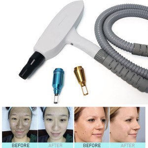 nd yag laser , nd yag tattoo removal, tattoo removal , carbon peeling