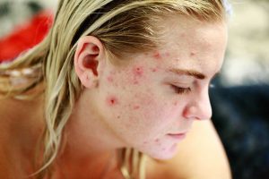 Acne Scars Treatment | Acne Scar Removal Machine & Device | Pollogen