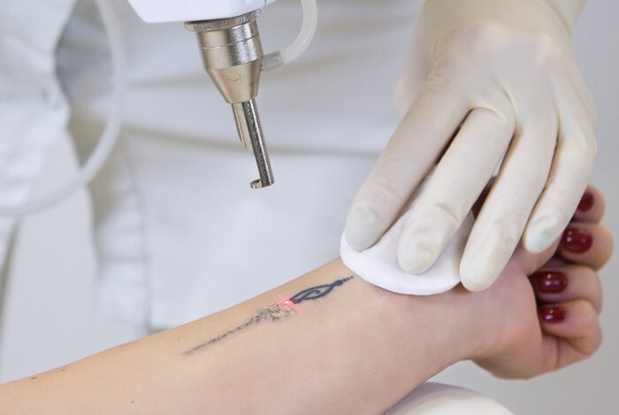 Laser Tattoo Removal Information